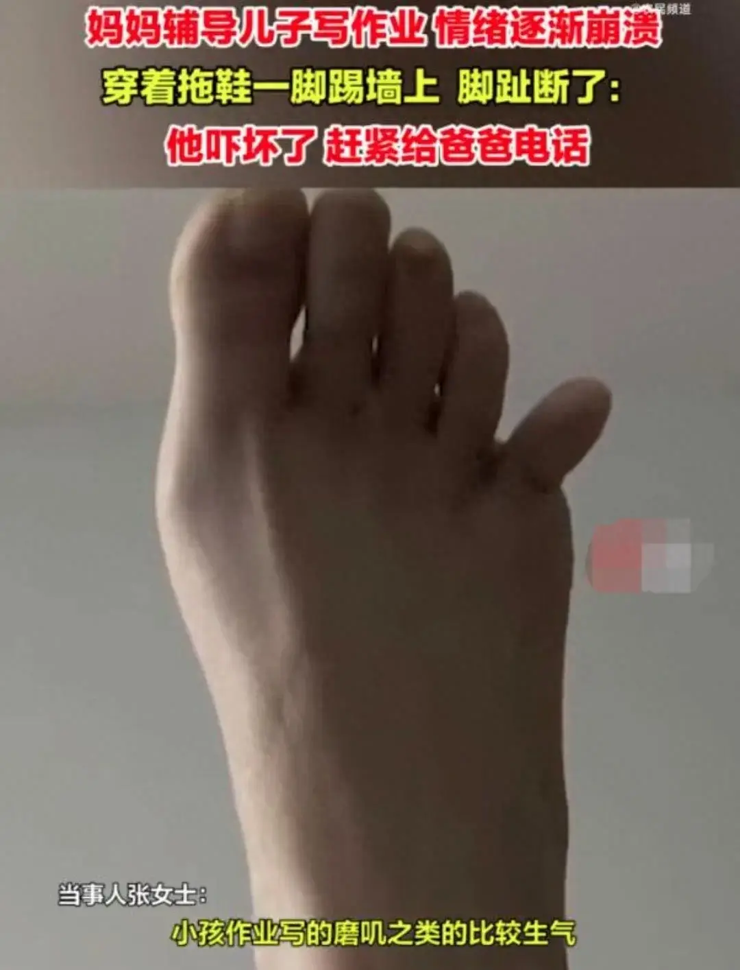 女子輔導(dǎo)兒子作業(yè)情緒崩潰踹斷腳趾
