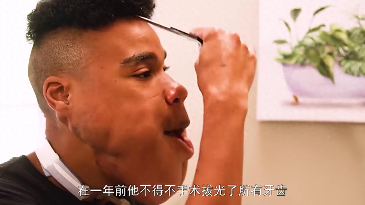 小伙嚼檳榔8年瓜子臉變方塊臉