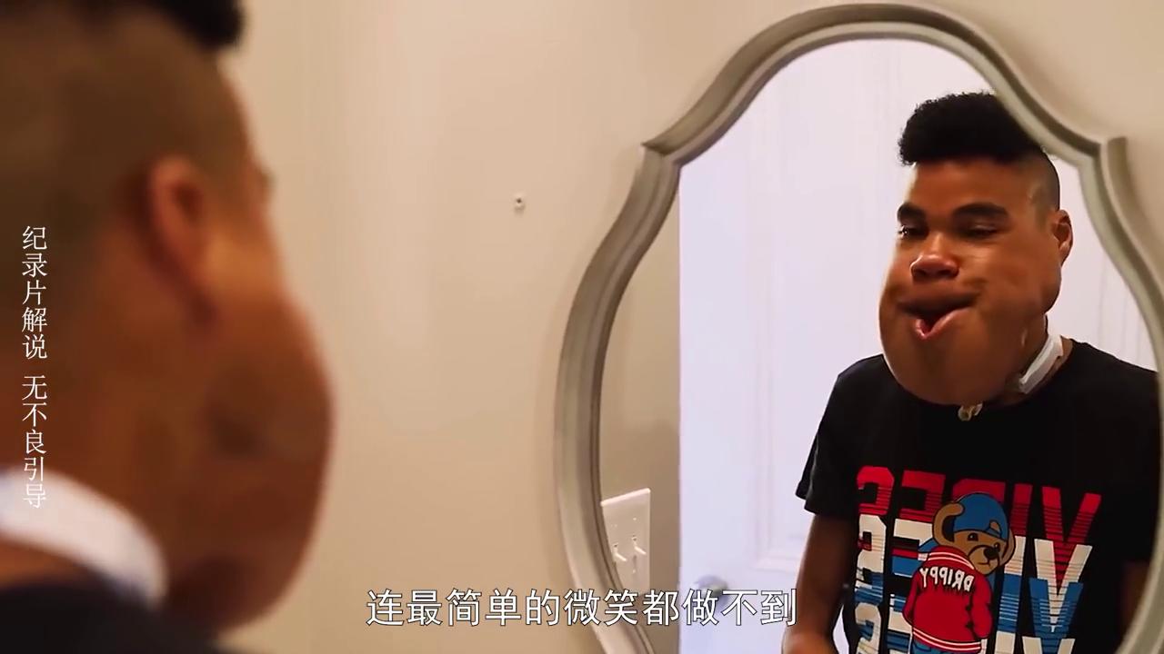 小伙嚼檳榔8年瓜子臉變方塊臉